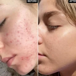 Hyaluronzuurserum|Hydraterend Serum^The INKEY List Niacinamide Serum